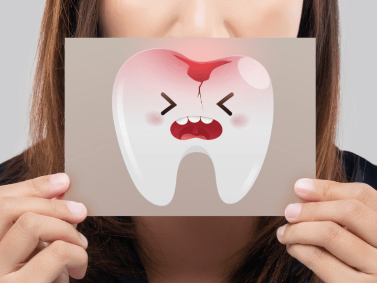 caries interdentales